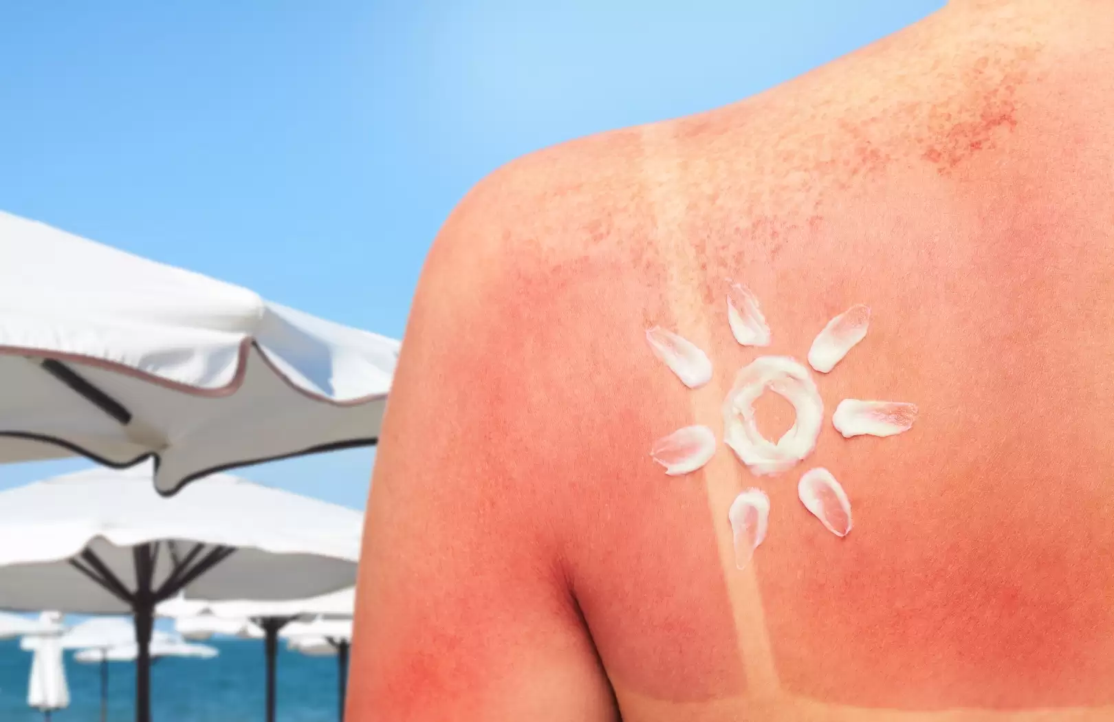 Organic Sun Burn Healing