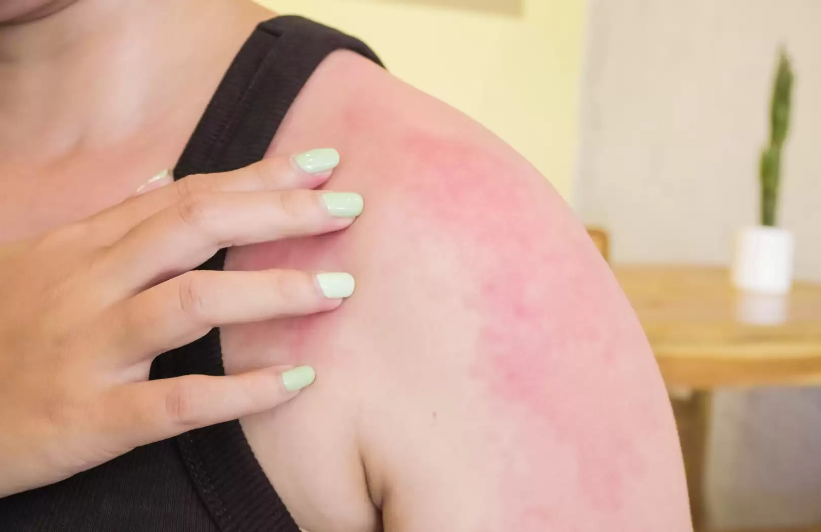 Organic Sun Burn Healing1