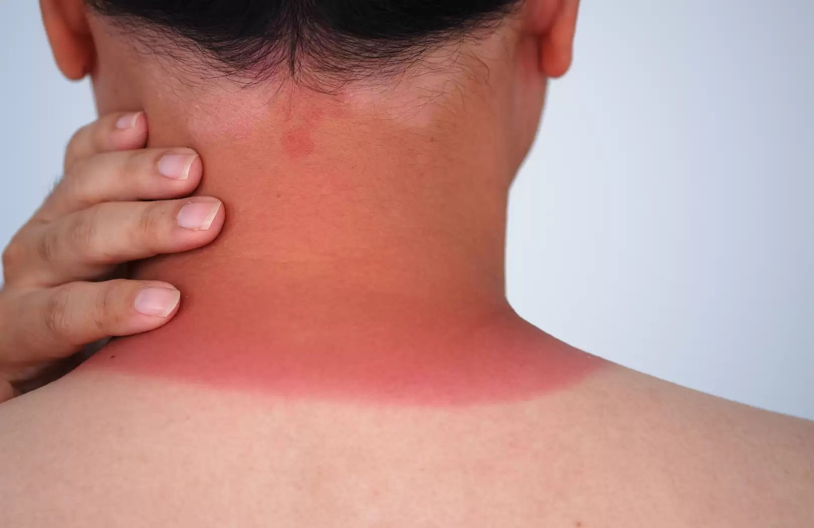 Organic Sun Burn Healing