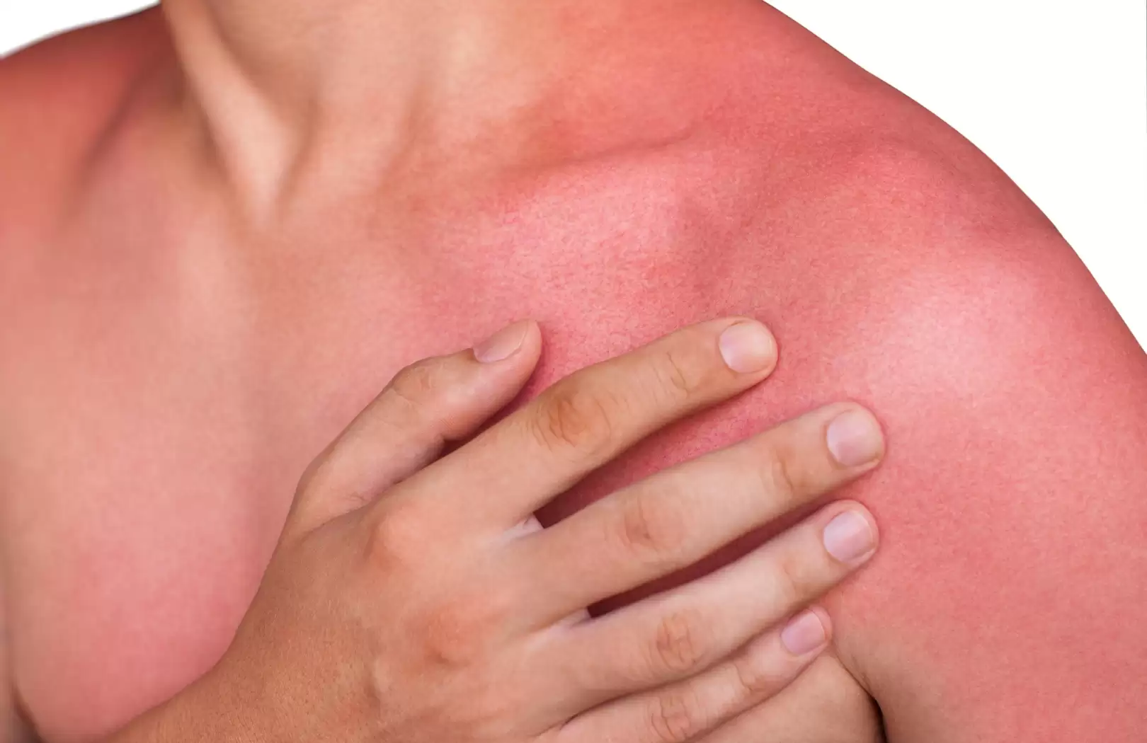 Organic Sun Burn Healing3